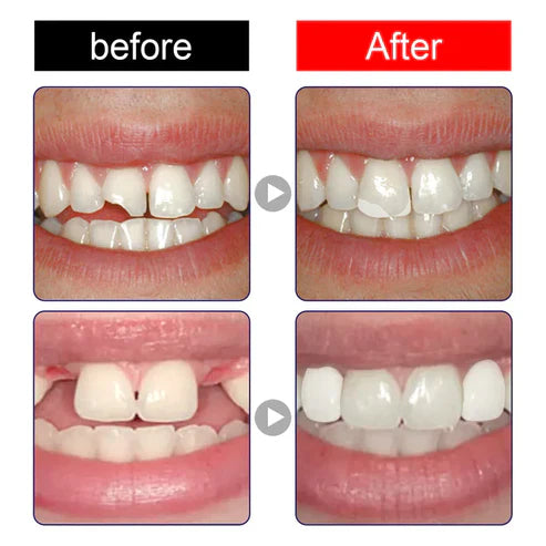 Sonrisa Perfecta Al Instante | Repara Tu Sonrisa | Implante De Diente