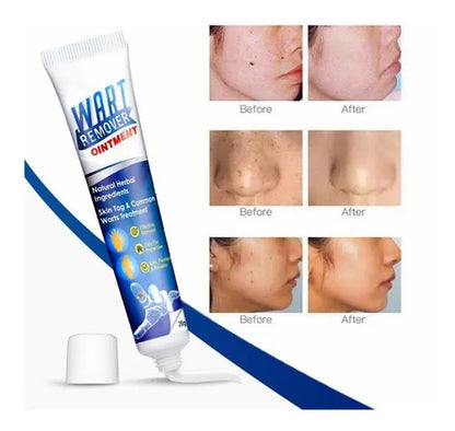 Crema para Eliminas Verrugas