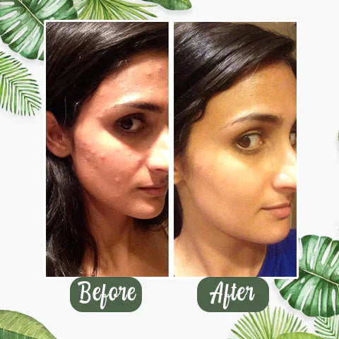 Elimina Impurezas del Rostro-Green Mask 2x1